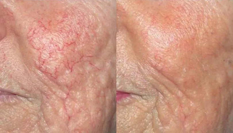 Couperose Coaguleren behandeling