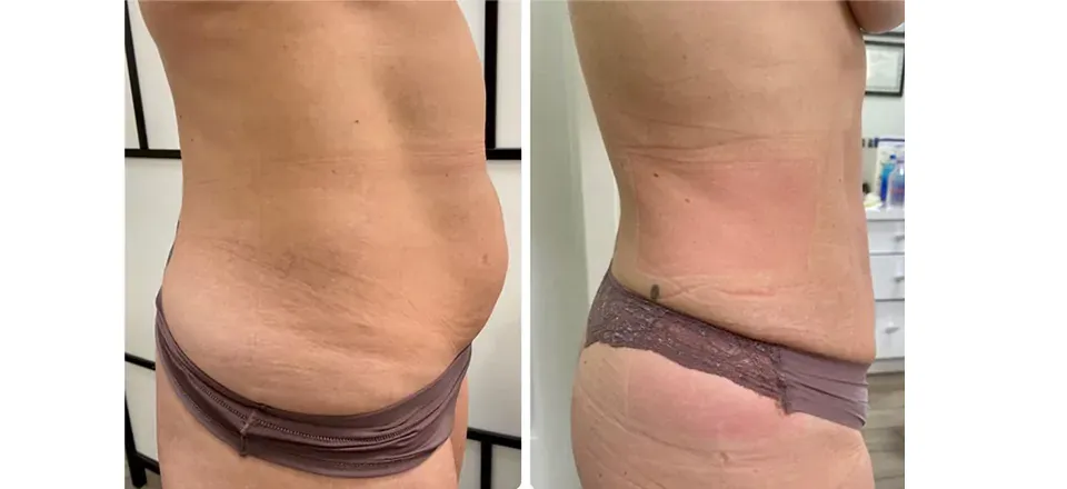 Cavitatie behandeling